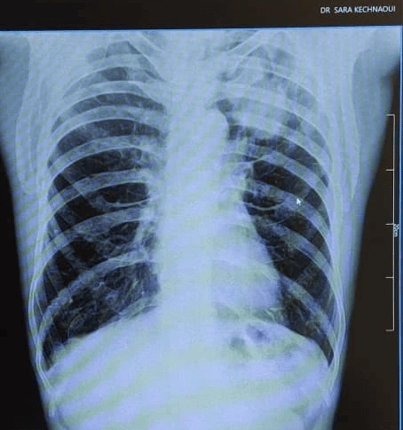 cabinet du dr Sara Kechnaoui - Néoplasie broncho-pulmonaire radio à Béni Mellal