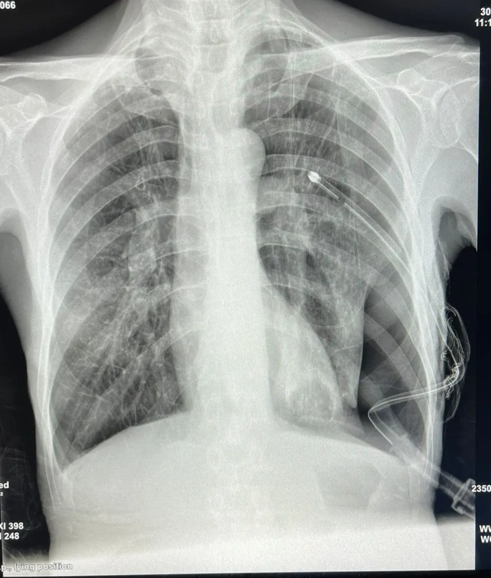 cabinet du dr Sara Kechnaoui - Pneumothorax à Béni Mellal