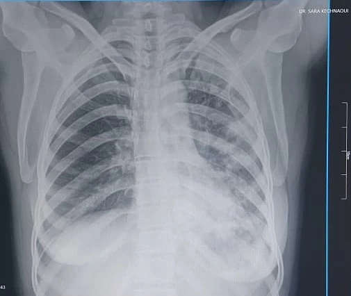 cabinet du dr Sara Kechnaoui - Tuberculose pulmonaire à Béni Mellal